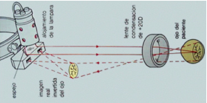 Imagen esquema Oftalmoscopia binocular indirecta